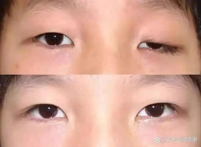 重症肌无力的眼睑下垂和复视