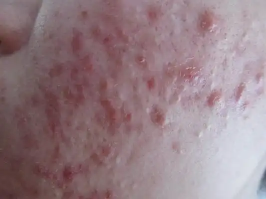 血热的症状痘痘图片8