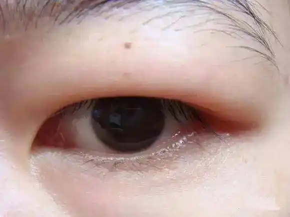 上眼睑脂肪厚的可以做埋线双眼皮吗?