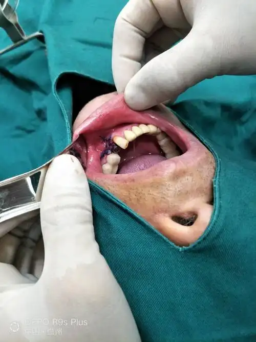 魅力牙科种植牙