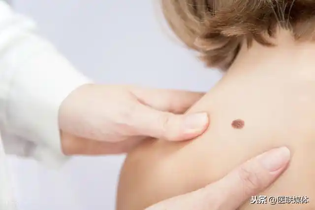 身上有这3种痣,别以为就是正常的