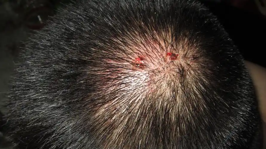 求妙手治疗穿凿性毛囊炎