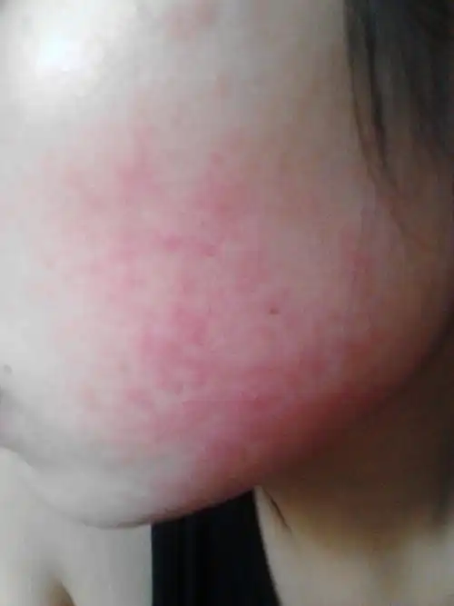 我的脸上红红的一大片,而且很痒,越抓越大,这是过敏了吗?_百度知道