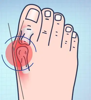 拇外翻会有脚部疼痛怎么回事,牛江红介绍