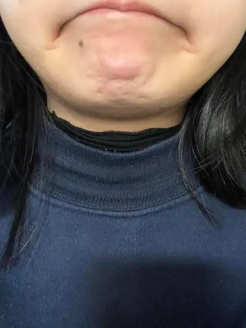 姐妹们下巴长了个大包是啥?痘吗?