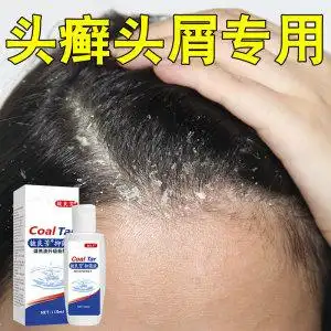 头痒有疙瘩毛囊炎治顽固性皮癣皮痒头癣药膏治头部银屑专用洗发水