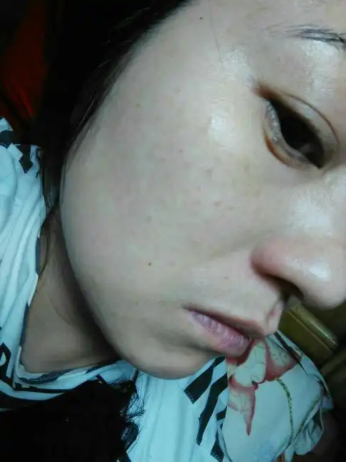 脸上两侧长了很多暗疮一样的红豆豆～一两个月了～都没消～不知道是