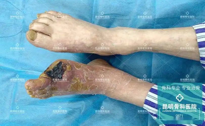 得了糖尿病足只能等截肢昆明骨科骨搬移让足部枯肢逢春