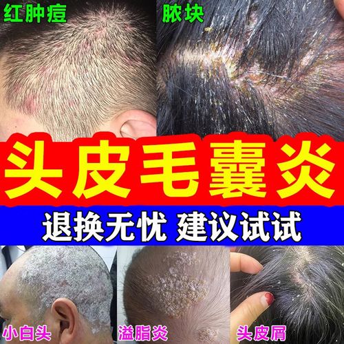 毛囊i炎头皮痒脂溢性皮炎洗发水治疗头部头皮痒有疙瘩的药头皮癣银屑