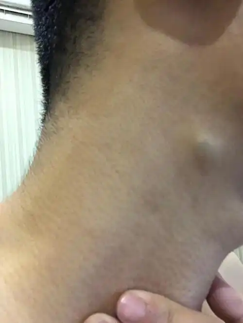 脖子上长了肉疙瘩.