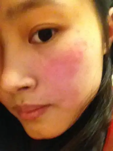 你好,这两天脸突然红了没有疼痛,痒的感觉,吃了一点榴莲,不知道是不是