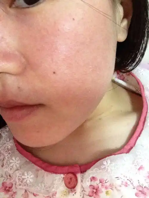 脸上长角质怎么办 脸上角质多怎么去除