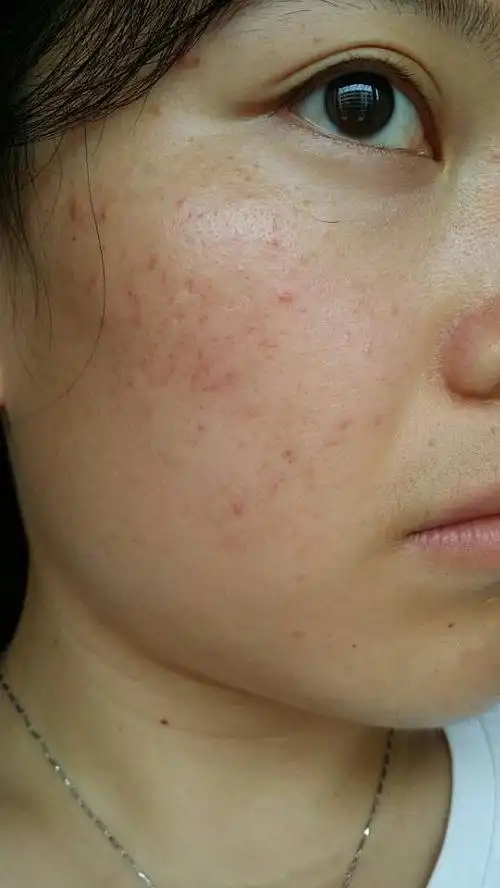 油出的也多,皮肤也干.