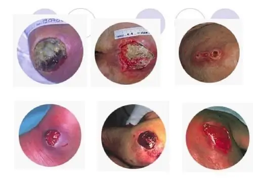 关爱健康_通海县人民医院普外科9月家庭随访