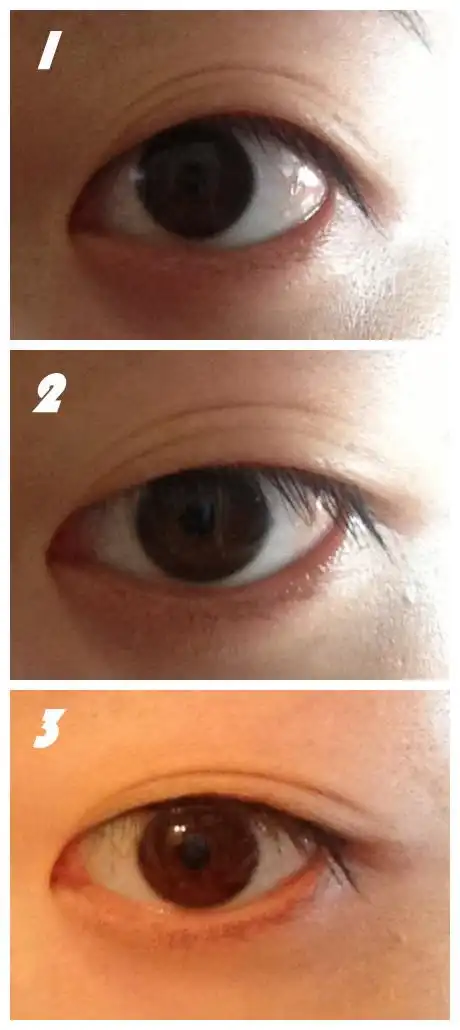 我的双眼皮为什么每天早上起床都变很多层?