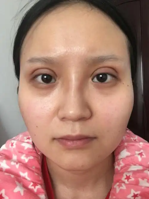 埋线双眼皮太深太宽