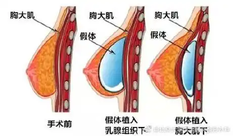 假体隆胸#做了假体隆胸后注意事项: 1,观察引流量,疼痛情况,乳头妇貂