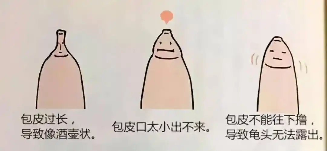 10个男孩8个有这个困扰,一定要做手术吗?