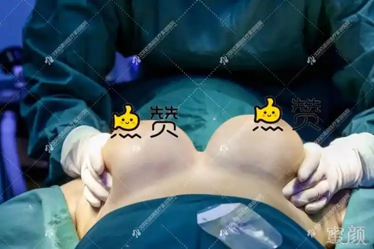 总结:自体脂肪隆胸更适合脂肪细胞多,想达到丰胸 瘦身二合一的效果.