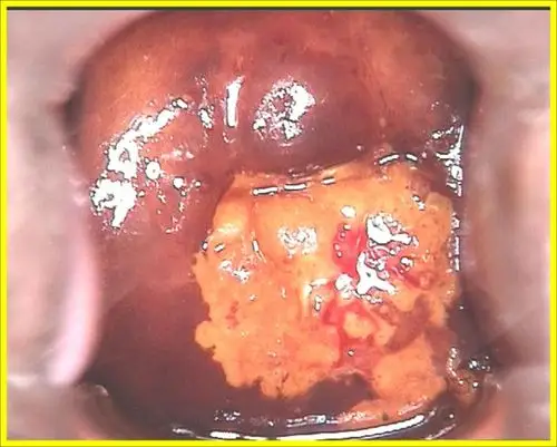 希望悲剧不再上演_宫颈