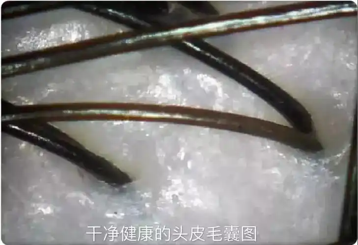 岳灵科普 | 为什么养发,需先养毛囊?_头发