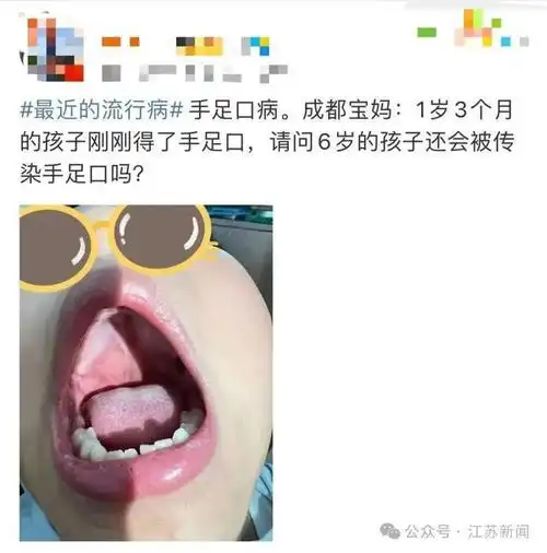严重可致命!|疱疹|症状|传染性|手足口|急性呼吸道传染病_网易订阅