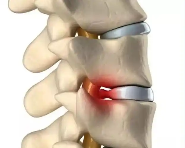 并且大部分人都是腰4腰5,腰5骶1发生突出!