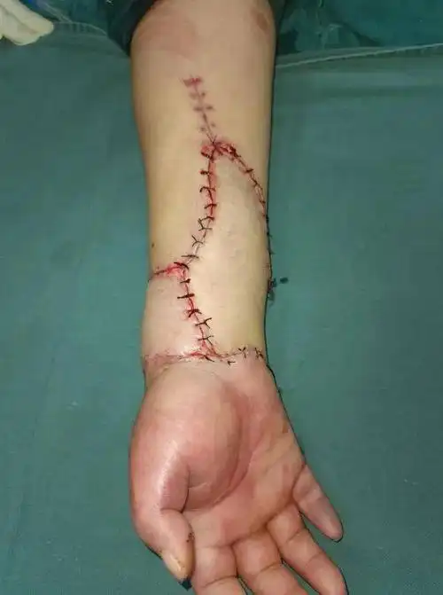 泸州男子右手被搅拌机连根拔起医生妙手回春断肢再植