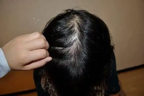 女性脱发的原因和治疗,患者须知,别等掉光了!