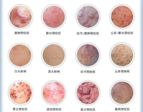 松矾散外敷治疗毛囊炎