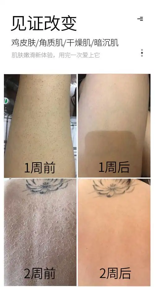 鸡皮救星去鸡皮疙瘩蛇皮去角质身体磨砂膏全身洗澡沐浴盐