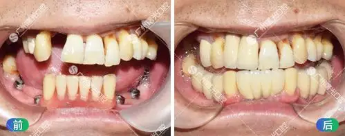 退休老伯种植牙术前术后对比组图