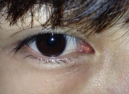 请问我内眼角里长的红色肉疙瘩是什么东西?