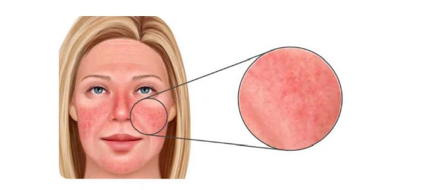 深圳汉古中医馆面部痤疮反复发作引火归原消疮焕颜