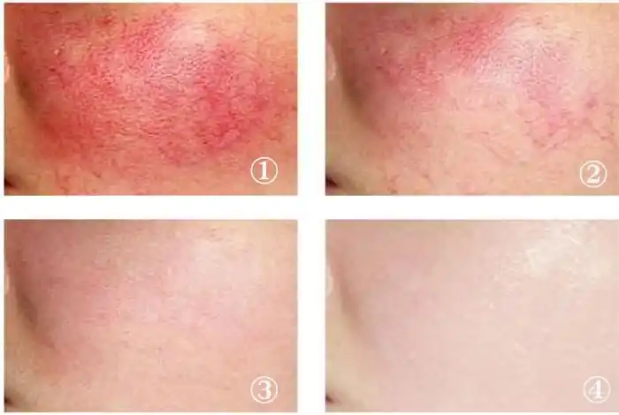 红血丝怎么养护好?