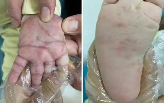 经典图片:疥疮在不同年龄阶段的表现