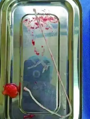 好吓人!女子乳房里取出20厘米的寄生虫,吃这些东西一定要小心!