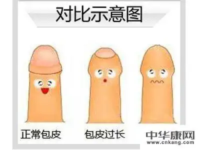 包皮过长不用怕,学会护理它