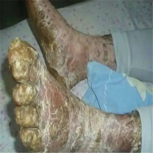 性病艾滋病人双脚图片