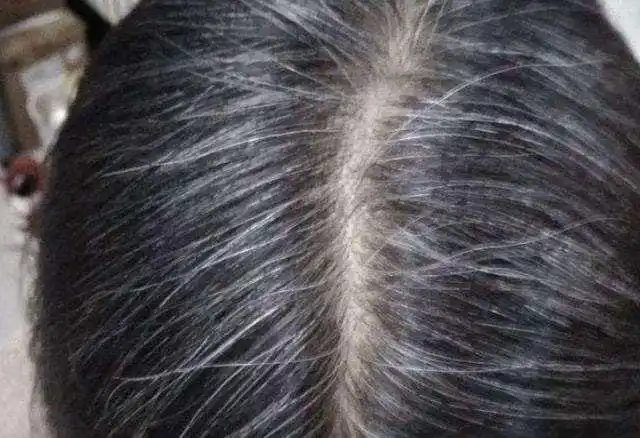 医生:可能是缺乏4种营养|白发|秀发_网易订阅