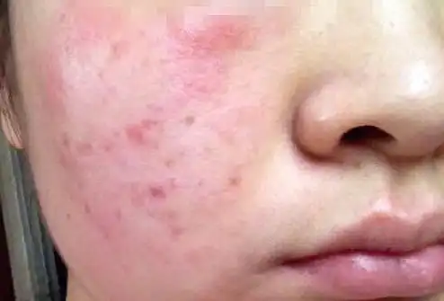 造成肌肤敏感的原因是什么?