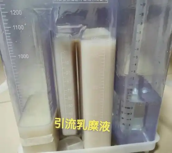 西北首例淋巴介入治疗儿童难治性乳糜胸伴骨质破坏顺利完成