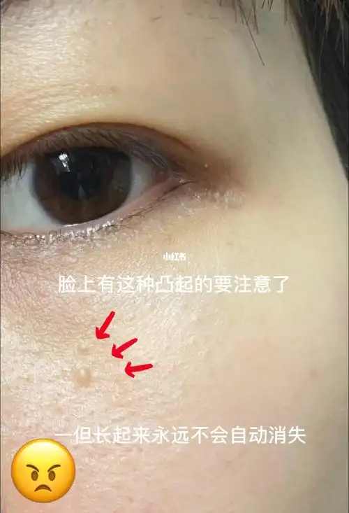 眼睛下方长凸起的小疙瘩