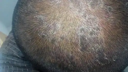 头皮特别多刚洗完一会儿又很多,一拍就像下雪一样,同事看到了还以为我