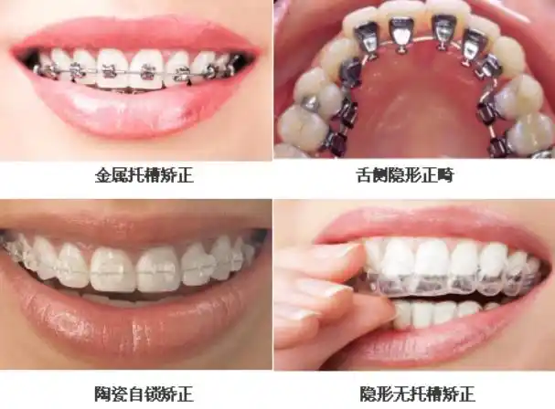 牙齿不整齐该怎么办,牙齿矫正,牙齿不整齐该怎么办,牙齿不齐怎么办