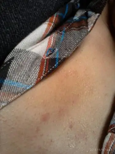 热心网友  2013-11-10   展开全部 病情分析: 这是一种遗传性皮肤病