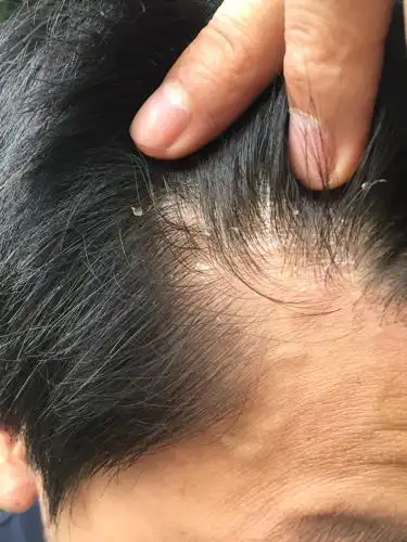 头皮屑多,头皮得了什么病,刚洗完头一干,马上又起一层头皮了,请仔细看