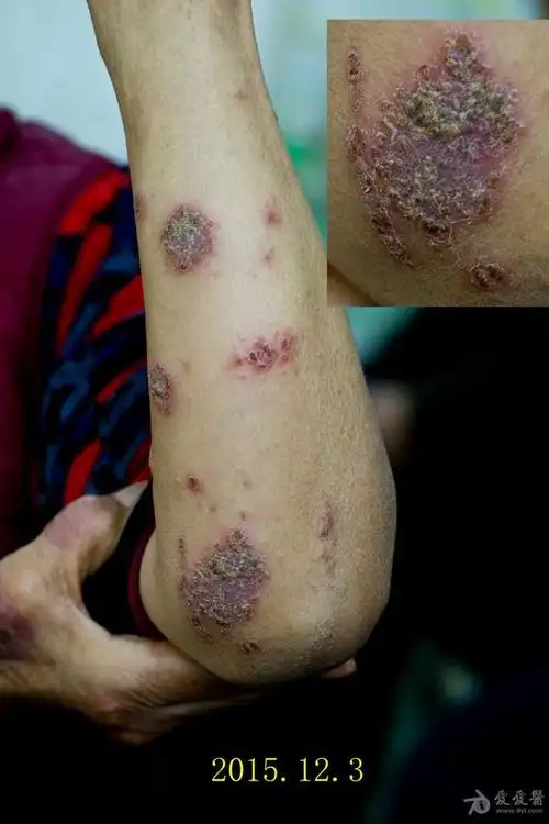 前泛发湿疹一例治疗6天后的图片