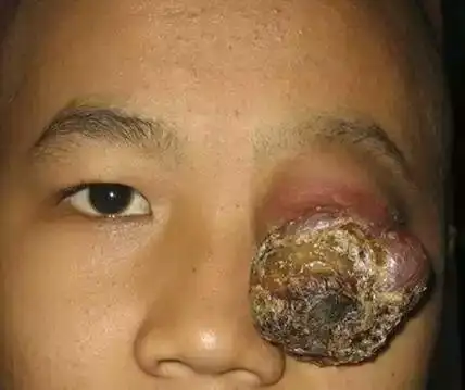 横纹肌肉瘤的症状