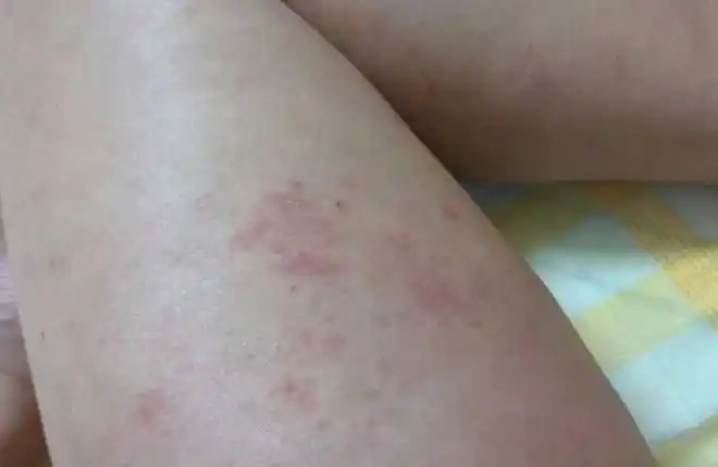 00后情侣每周"857",双双长出"红点",医生:2个状况早查hpv|病毒|瘙痒